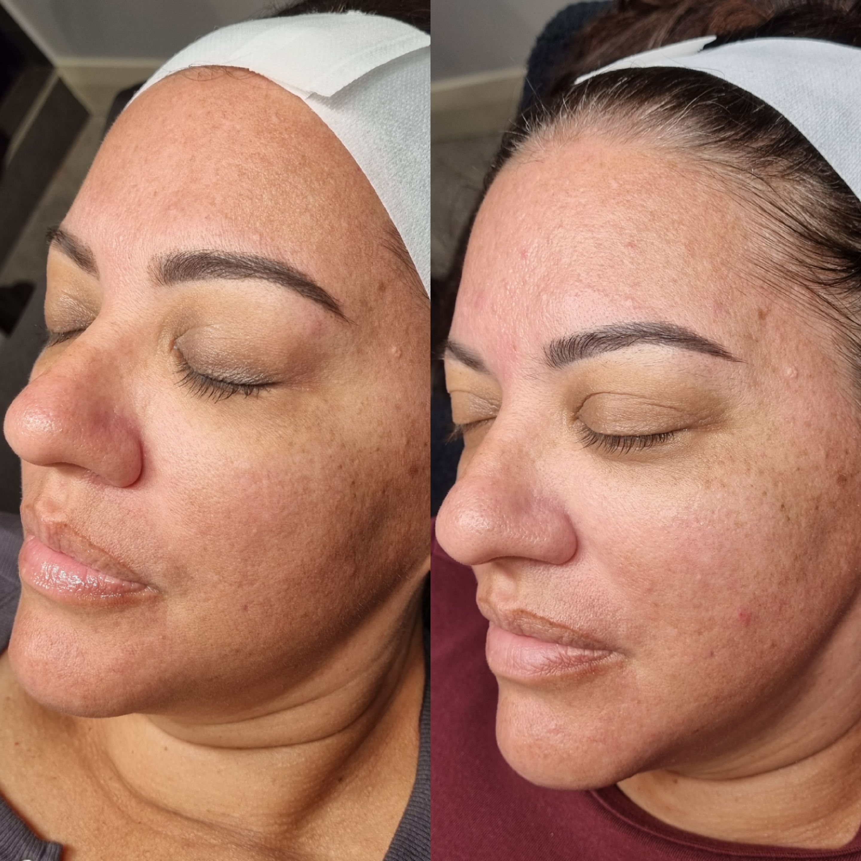 SQT bio-microneedling before and after — two sessions